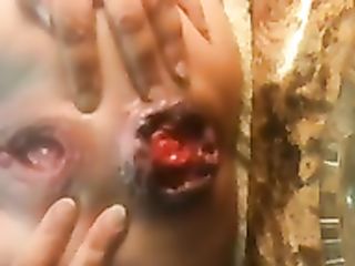 anal habilities, prolapse, holes