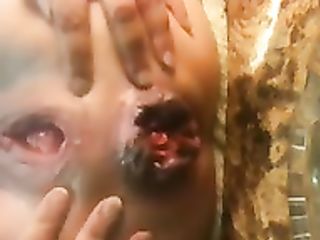 anal habilities, prolapse, holes