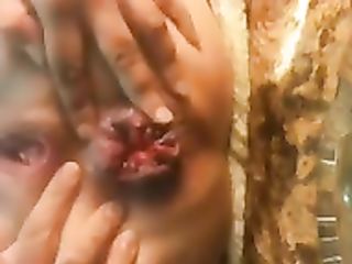 anal habilities, prolapse, holes